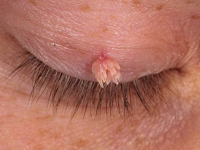 папилома на глазу