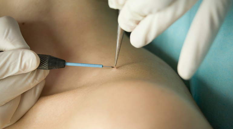 процесс удаления папиломы