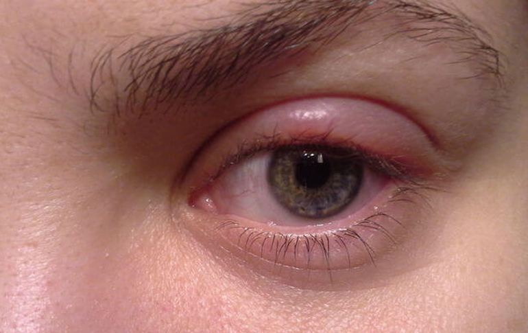 опухшее верхнее веко