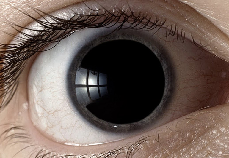 Мидриаз, сильно расширеный зрачек
