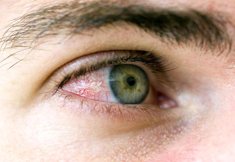 воспаления сосудистой оболочки глаза