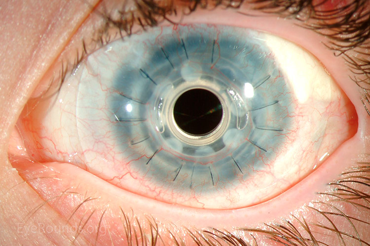 кератопротезирование несквозной имплант