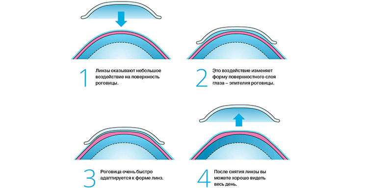 Принцип действия ортокератологических линз