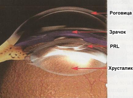 intraokuljarnye_linzy