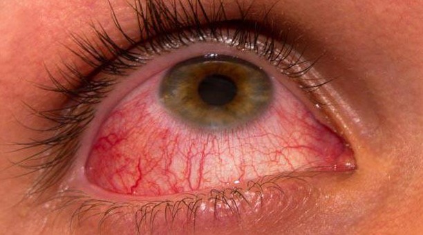 Sindrom-suhogo-glaza