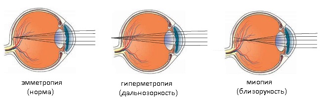отклонения зрения от нормы