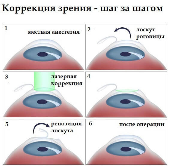 шаги коррекции зрения
