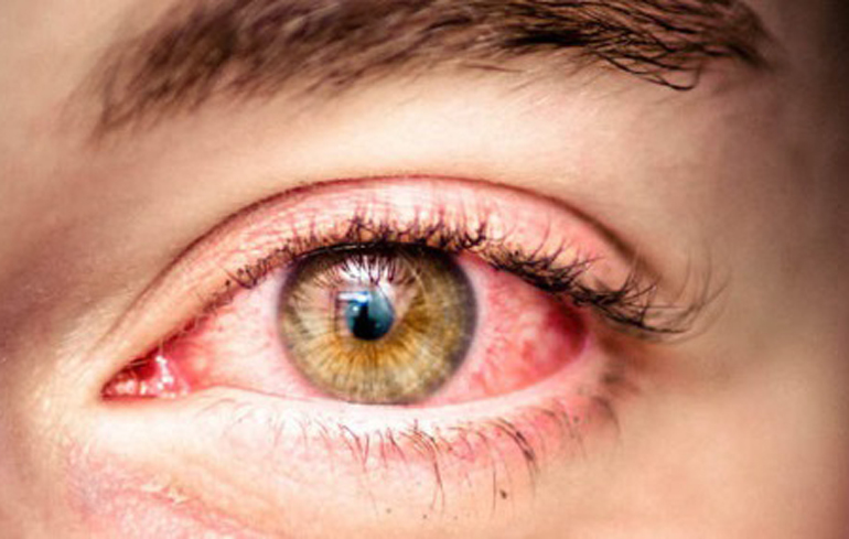 красный воспаленный глаз