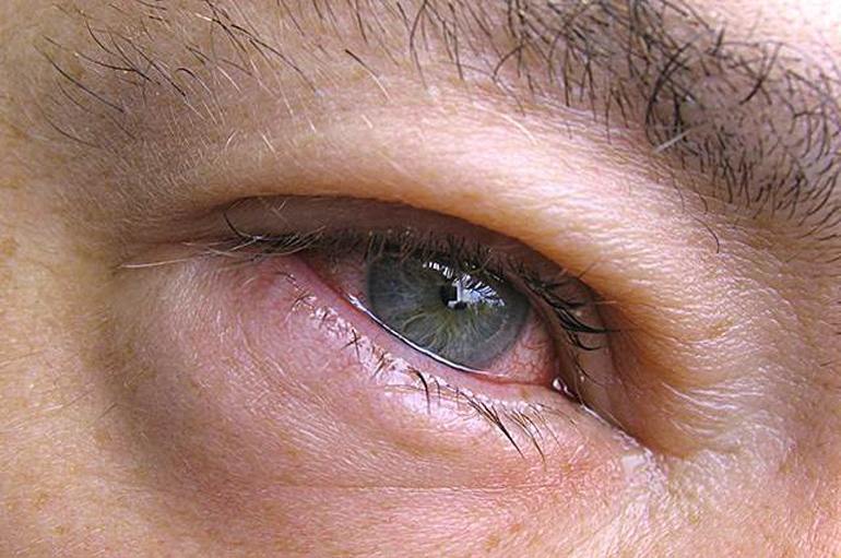 Аденовирусный конъюнктивит