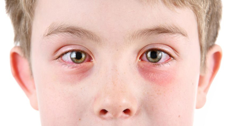 Аденовирусный конъюнктивит у ребенка