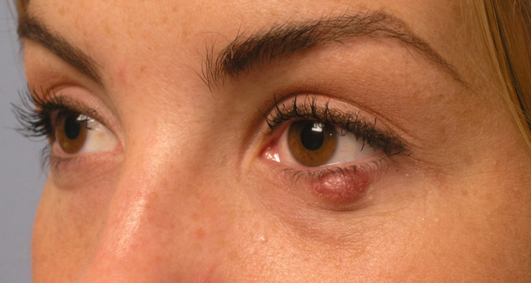 халязион на нижнем веке