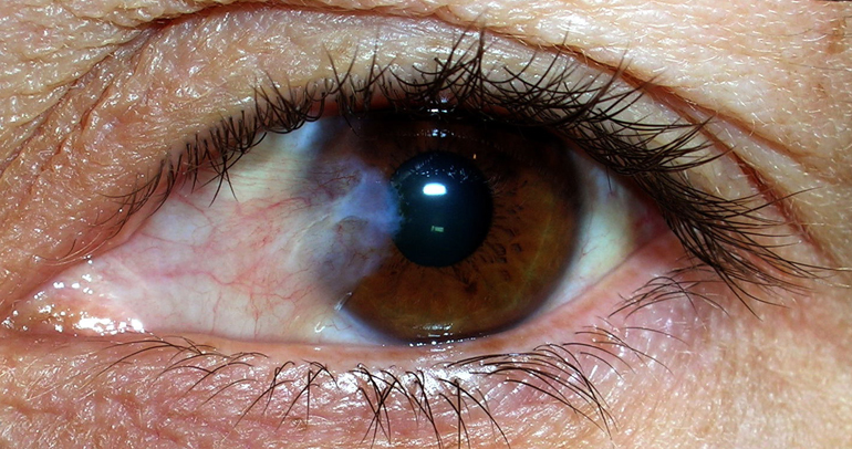 глаз и сращивание сетчатки