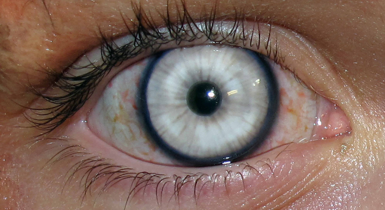 странная белая радужка глаза