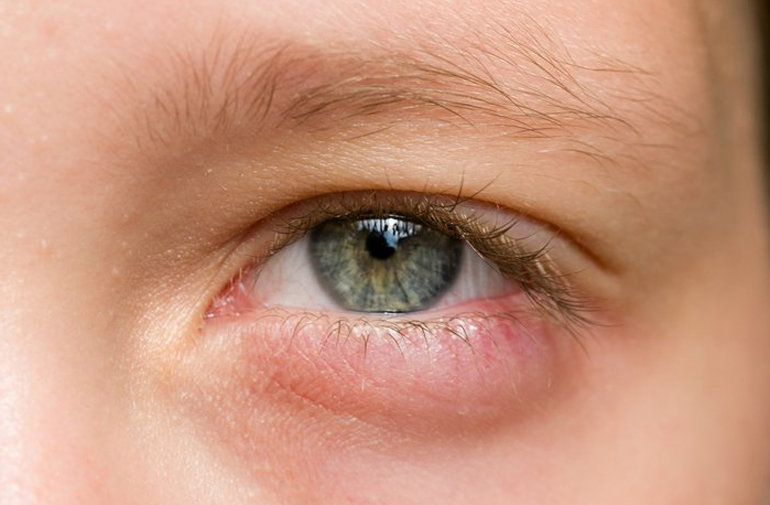 отекшее нижнее веко