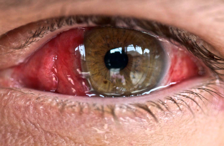 очень красный глаз